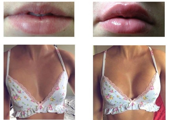 Remplisseur cutané d'injections de lèvre d'implant d'acide hyaluronique de remplisseur d'injection d'élargissement de sein