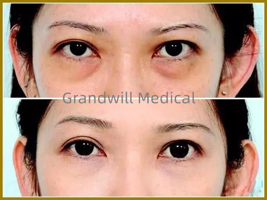 Remplisseurs cutanés de massage facial d'acide hyaluronique pour le cercle remplissant d'oeil de cuvette de larme