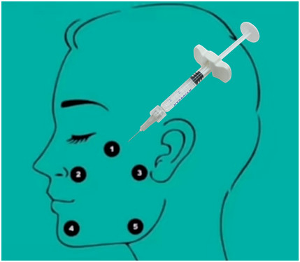 gel lié non croisé d'acide hyaluronique de remplisseur d'acide hyaluronique de 32mg H-HA L-HA