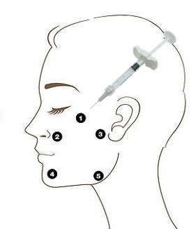 Remplisseur lié non croisé d'acide hyaluronique d'OEM Profhilo H+L 32mg 5 points d'injection