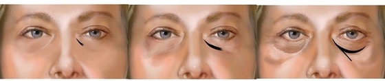 la solution injectable d'acide hyaluronique de 1ml 2ml enlèvent observe le traitement foncé de cercles