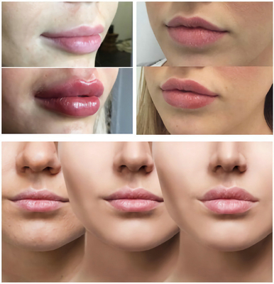 Lignes douces/lèvres dodues avec le remplisseur injectable 1ml 2ml 5ml d'acide hyaluronique