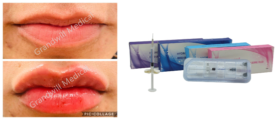 Remplisseur cutané lié croisé d'injection d'acide hyaluronique de sodium pour les rides faciales de plénitude de lèvre