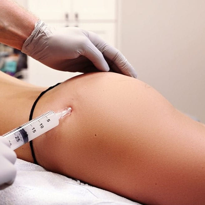 Acide hyaluronique lié croisé injectable Filler cutané Gel hyaluronate sodique