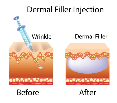 Produit de remplissage d'acide hyaluronique Gel injectable de hyaluronate de sodium modifié pour le visage et le corps