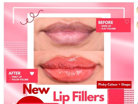 HYDROIAM Kiss avec B12 Ha Remplisseur de lèvres rouges Remplisseur d'acide hyaluronique Remplisseur fournit un volume et une couleur naturels