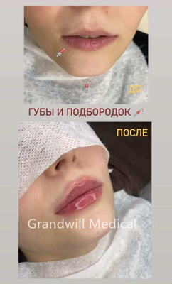 24 mg/ ml de remplissage cutané injectable à l' acide hyaluronique pour lissage des rides