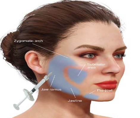 Acide hyaluronique HA remplisseur de calcium hydroxyapatite Obtenez un visage naturel avec une seringue de 1 ml