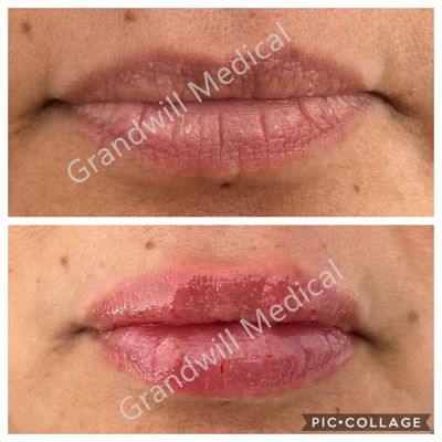Remplisseur cutané 1ml 2ml de gel injectable d'acide hyaluronique d'augmentation de lèvre