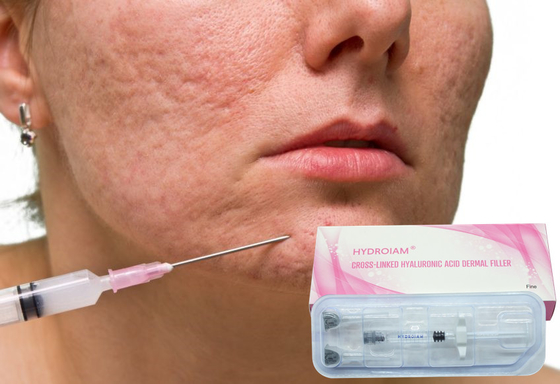 injection de gel de Hyaluronate du sodium 1ml pour enlever les rides faciales fines