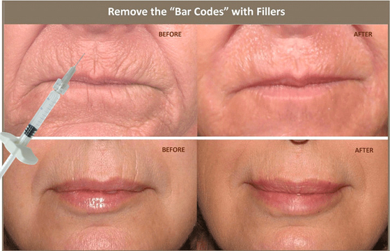 remplisseur cutané de l'acide hyaluronique 10ml injectable pour corriger l'asymétrie faciale
