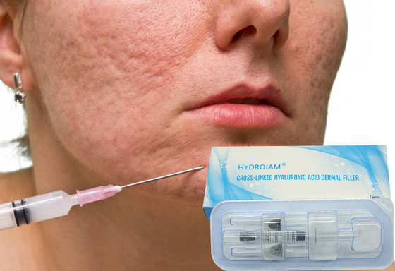remplisseur cutané de l'acide hyaluronique 10ml injectable pour corriger l'asymétrie faciale
