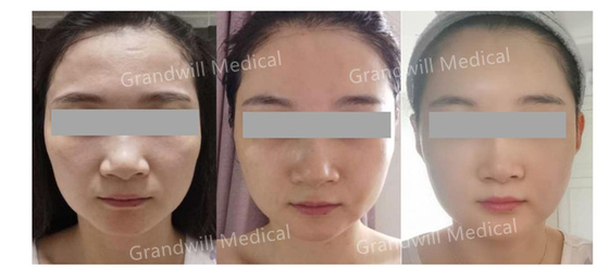 Le miracle cutané de remplisseur d'ha PCL de lifting touchent l'injection de Microneedling