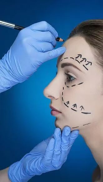 Lisse les rides et détermine la ligne de la mâchoire avec des remplisseurs cutanés faciaux 70% HA Lié croisé 24 mg 30% Hydroxylapatite de calcium