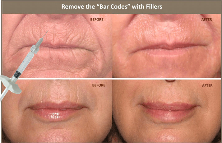 remplisseur cutané de l'acide hyaluronique 10ml injectable pour corriger l'asymétrie faciale