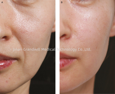 Miracle H L PCL Skin Booster Polycaprolactone en ligne fine remplisseur d'injection d'acide hyaluronique