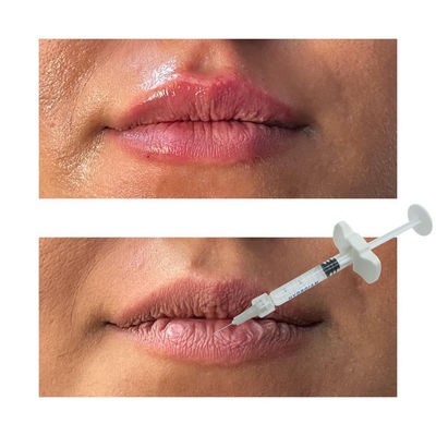 la croix cutanée de remplisseurs de la lèvre 1ml a lié le sodium Hyaluronate pour le Rhinoplasty
