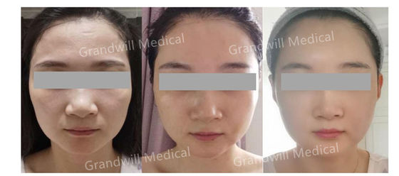 Remplisseur cutané stérile à l'acide hyaluronique lié croisé Conçu pour le contourage du visage naturel et le rajeunissement de la peau